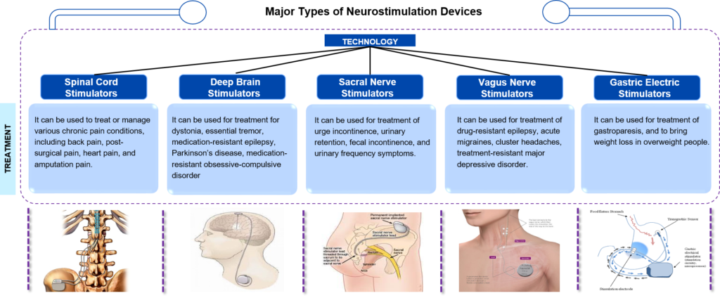 Different Types of Neurostimulation Devices 