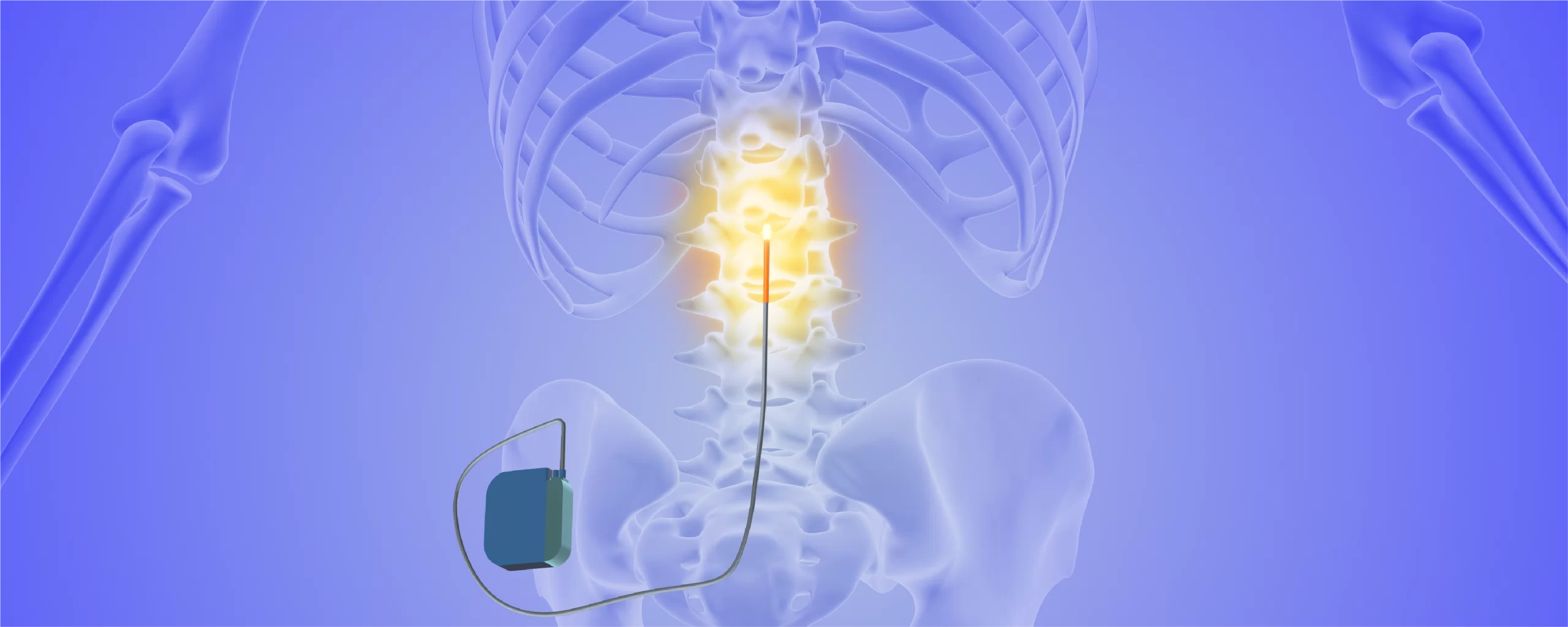 Advancements in Healthcare – Neurostimulation Devices