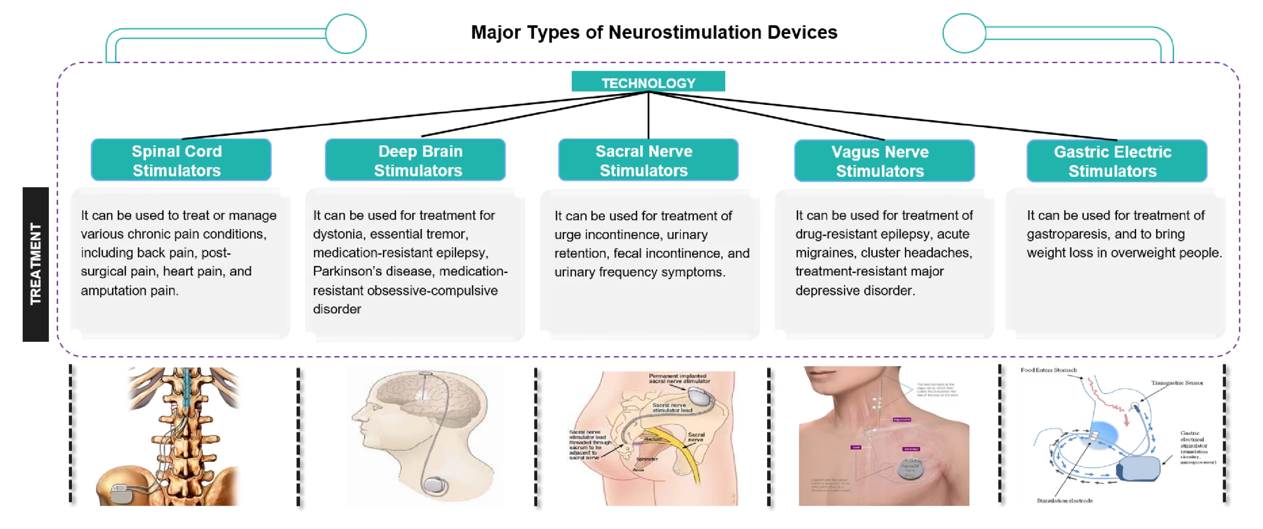 Different Types of Neurostimulation Devices