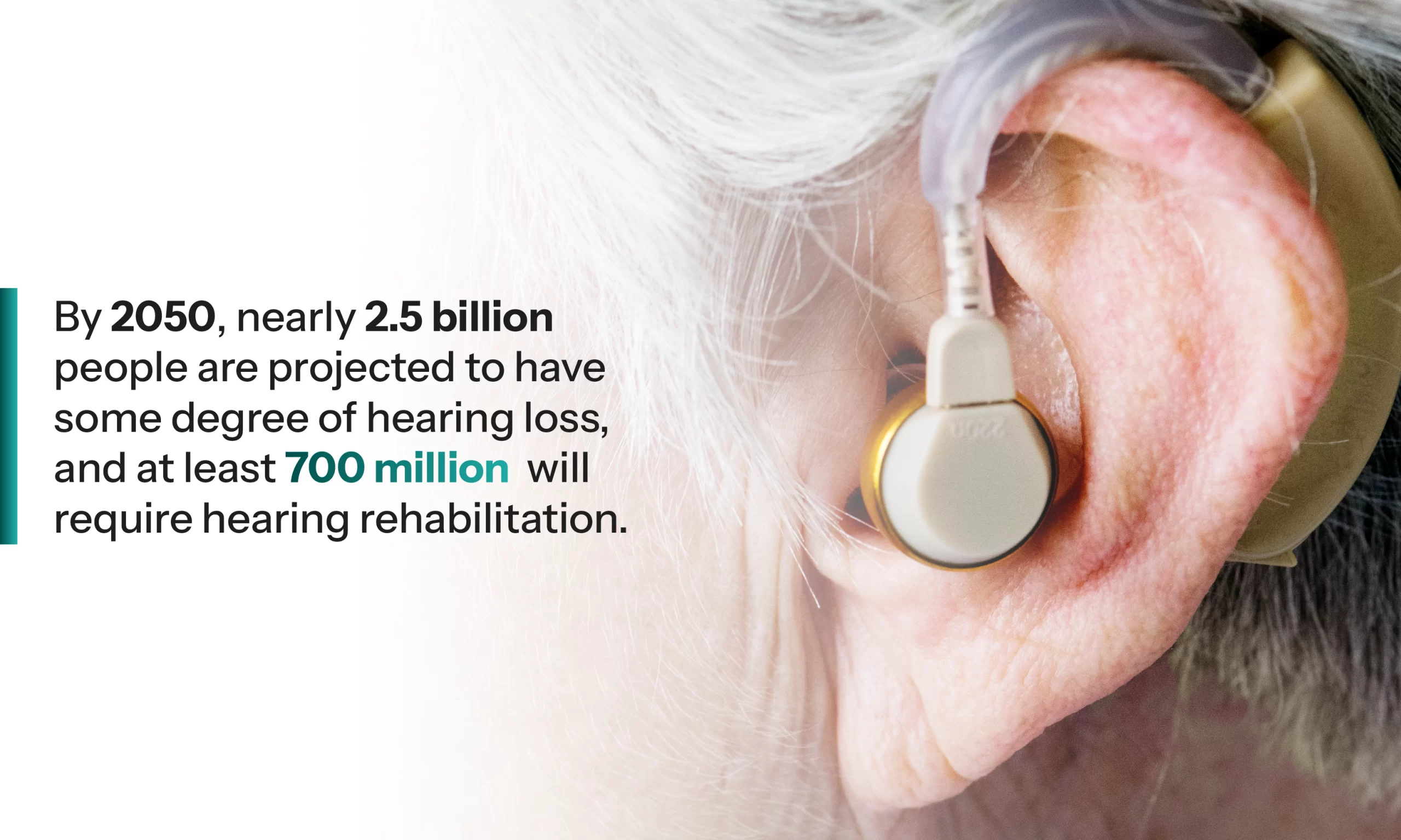 By 2050, nearly 2.5 billion people are projected to have some degree of hearing loss, and at least 700 million will require hearing rehabilitation.