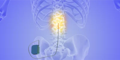 Advancements in Healthcare – Neurostimulation Devices